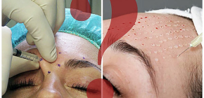 Botox hoặc biorevitalization: sự khác biệt là gì?