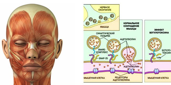 Vliv botulotoxinu na svaly