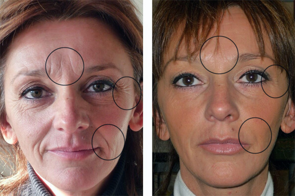 Effet Botox sur le visage