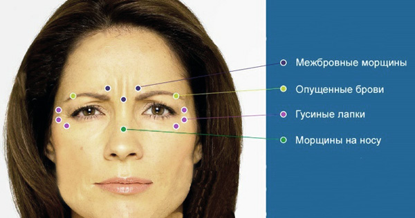 Точки за инжектиране на ботулинов токсин за коригиране на определени бръчки