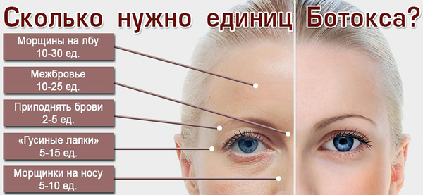 Броят на единиците Botox за премахване на различни бръчки