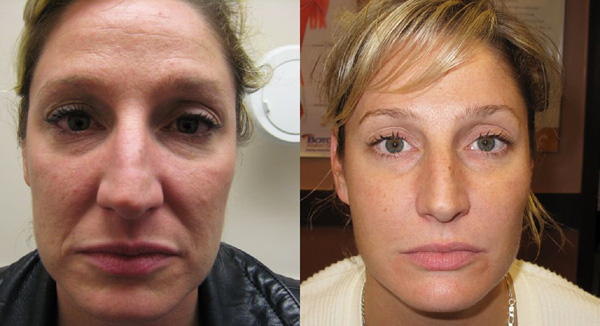 Correction complexe des rides nasolabiales avec Botox et des fillers