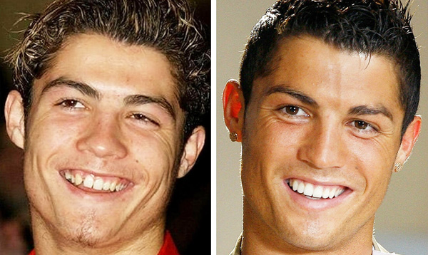 Correction des rides du visage chez Ronaldo