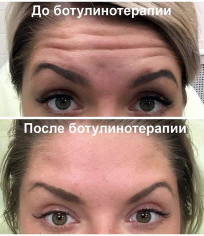 Botox contre les rides du front (avant et après les photos)