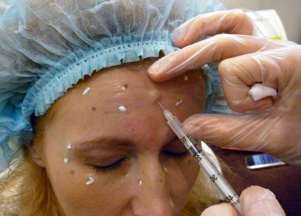 Le nombre d'unités de Botox est calculé individuellement